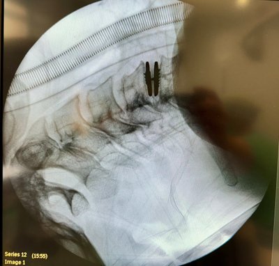 Mobilus kaklo tarpslankstelinis implantas