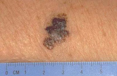 Melanoma