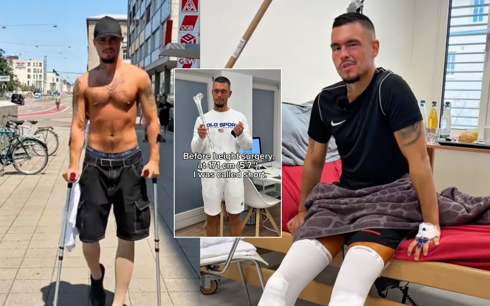 21-Year-Old German Undergoes Leg-Lengthening Surgeries, Gains 17cm in Height