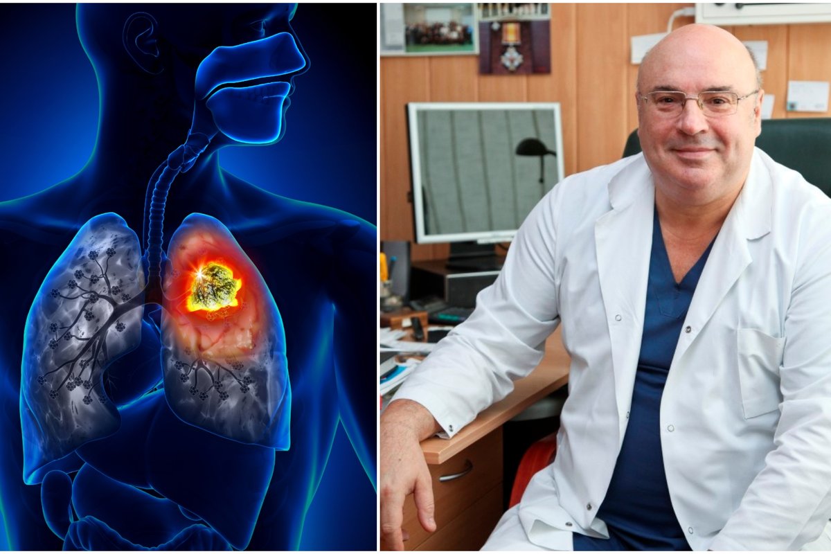 Plaučių vėžys – ne tik rūkančių liga: daktaras pasakė, kam jis gresia ...