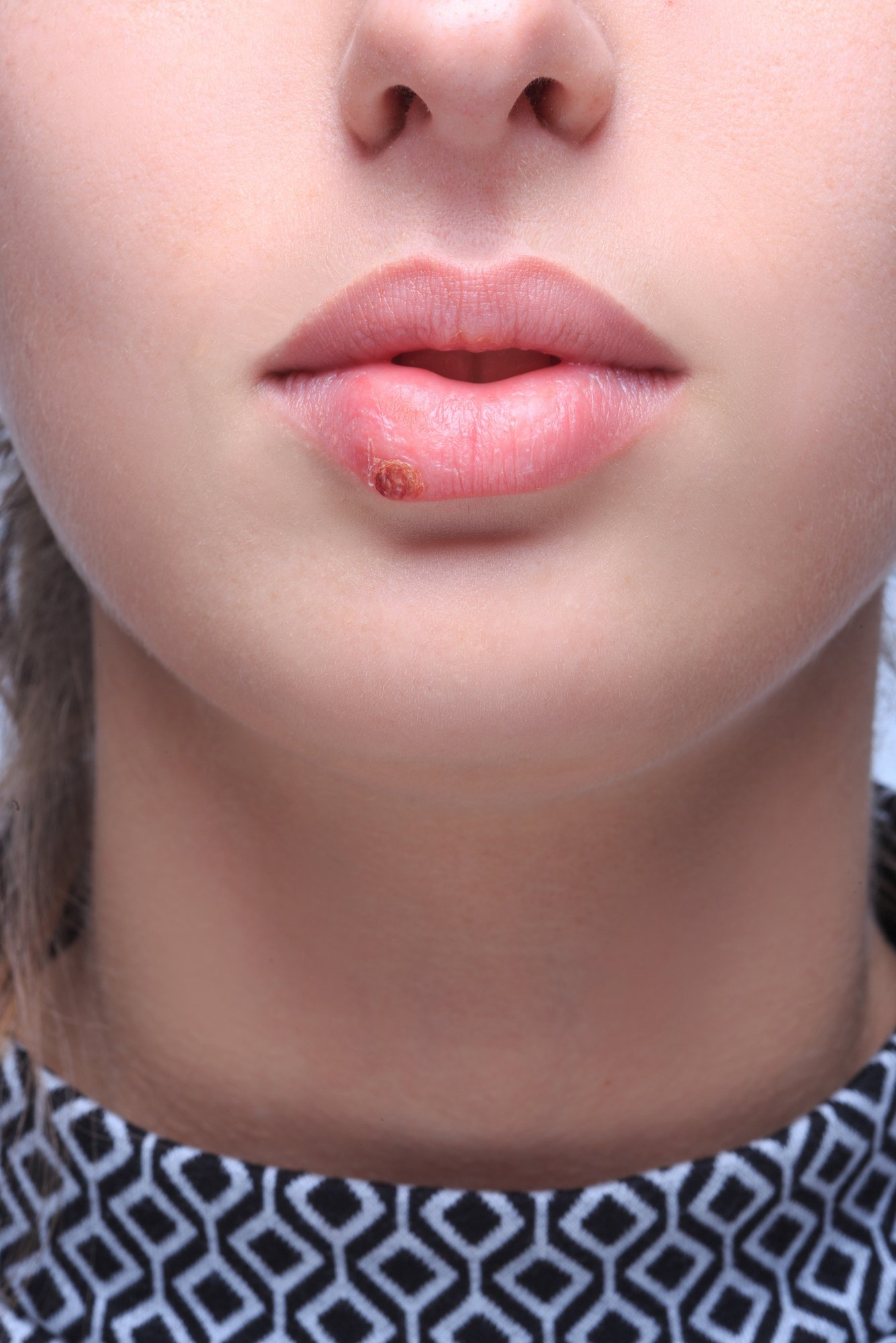 Герпетические высыпания на губах. Чем лечить малярию на губах быстро. Мазь от малярии на губах. Чем лечить малярию на губах быстро. Каланхоэ от герпеса на губах.