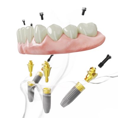 Naudojant All-on-4® gydymo metodiką visi vieno žandikaulio dantys atkuriami ant 4 implantų. „Nobel Biocare“ nuotr.