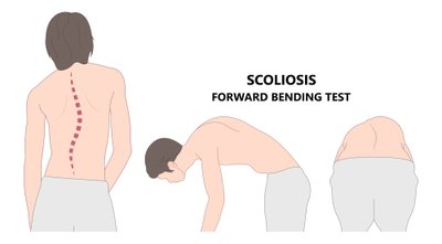 Skoliozės testas