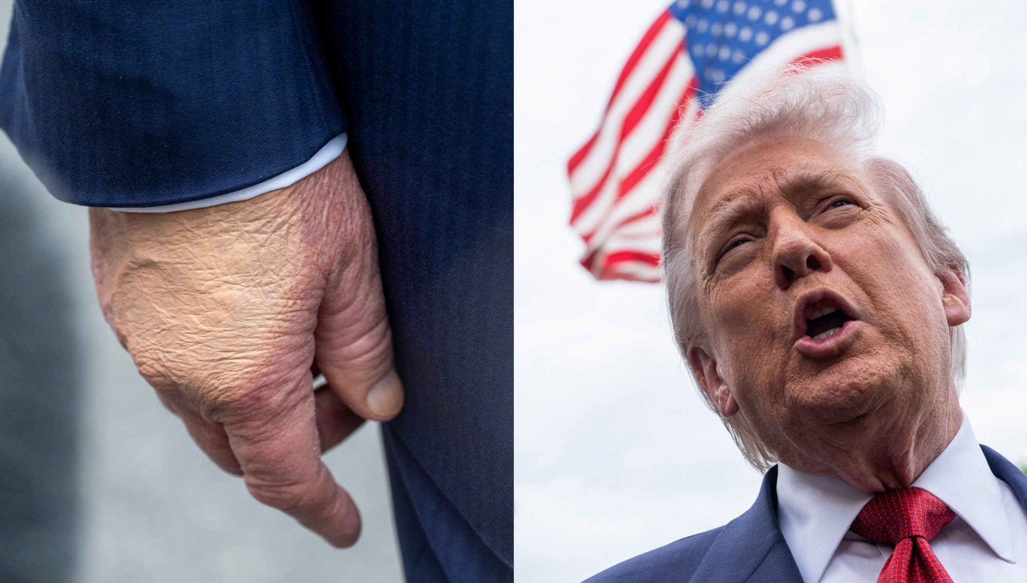 Trump's heavily made-up hands fuel health speculation