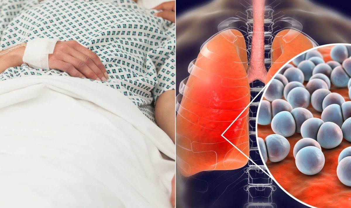 Skelbiama apie išaugusį sergamumą pneumokoko infekcija