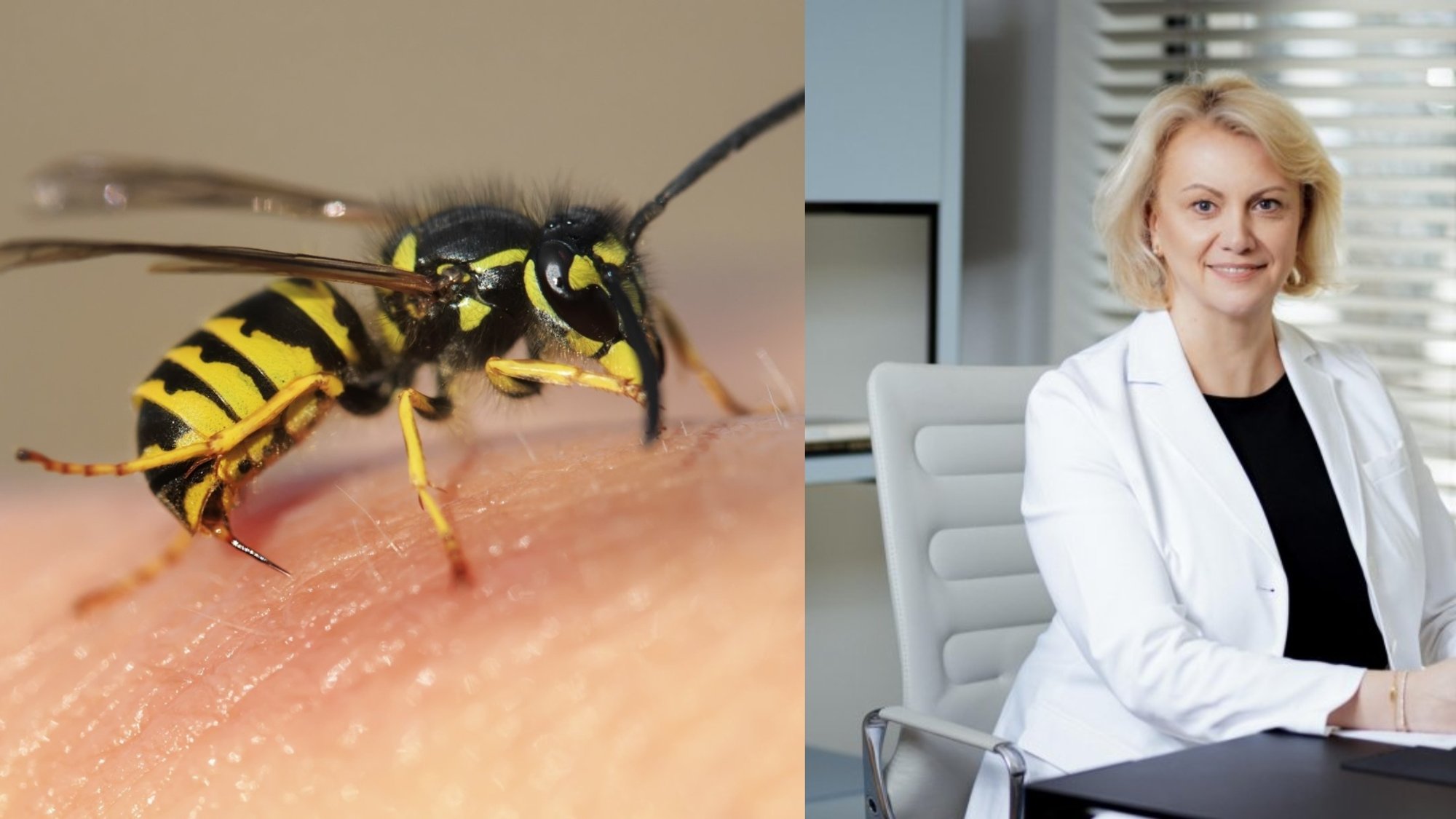 Reactions to stings can intensify: specialist explains when serious danger looms