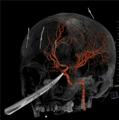 Peilis sustojo tiesiai prie pat miego arterijos