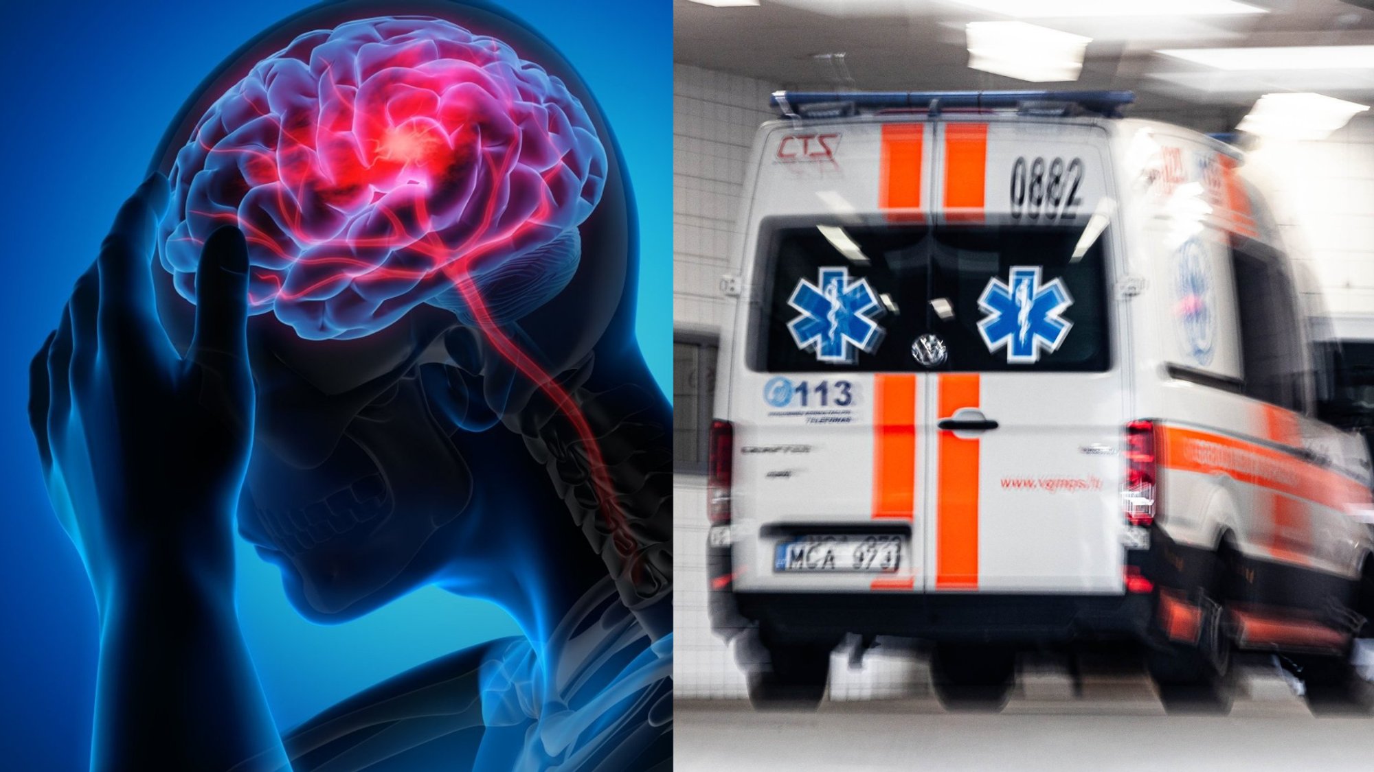 5 micro-stroke symptoms that are easy to overlook