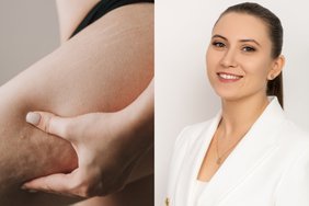Išvardino efektyviausias kovos su celiulitu priemones: yra ir mitas, kurį būtina paneigti