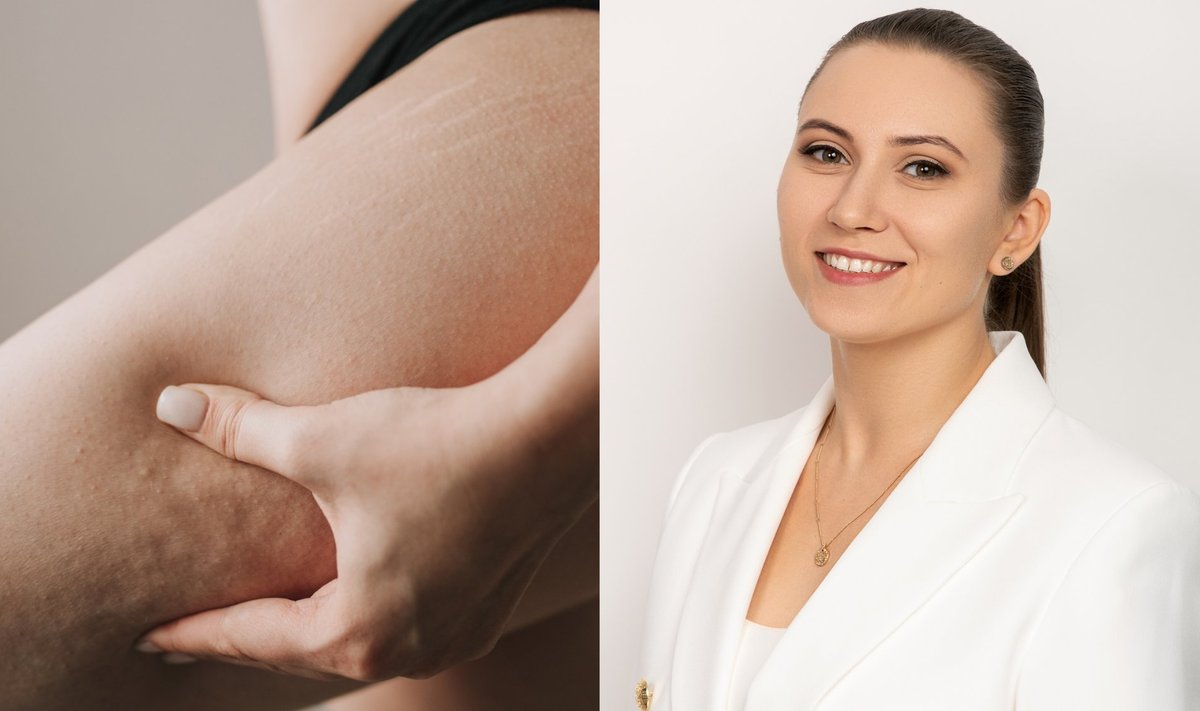 Celiulitas asoc. nuotr. ir SPA Vilnius kosmetologė-masažo meistrė Dovilė Ruminienė