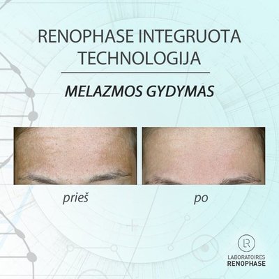  Melazmos gydymas 