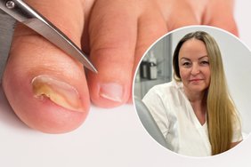 Kojų nagus gali traumuoti net kojinės – ilgainiui vaizdelis primena grybelį