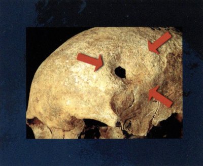 Marvelė, kapas 24 (150–300 AD). 45–50 m. moteris. 3,5 × 2 cm anga nuožulniais kraštais. Žaizda visai sugijusi. Trepanacinė anga atlikta skobimo technika.31