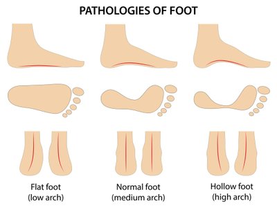 Pėdos skliautų išlinkimo tipai: normalus išlinkimas (normal); aukštas išlinkimas (high) ir plokščiapėdystė (flatfoot).