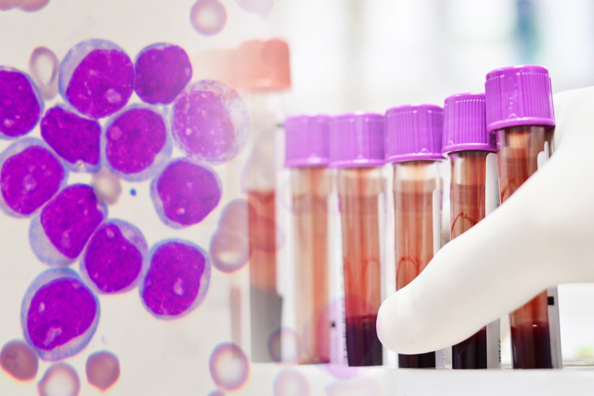 Standard Care: What is the Primary treatment for leukemia in Children? 2 Standard Care: What is the Primary treatment for leukemia in Children?