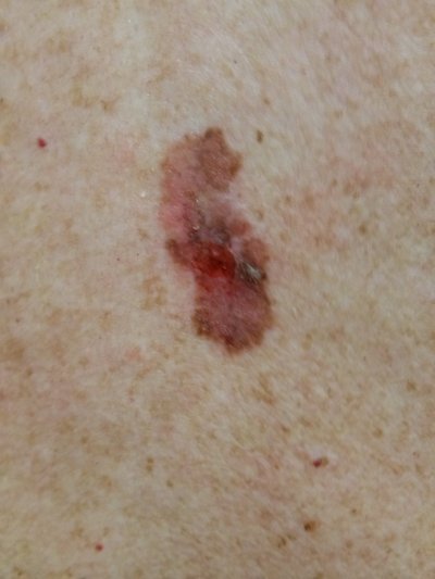 Melanoma