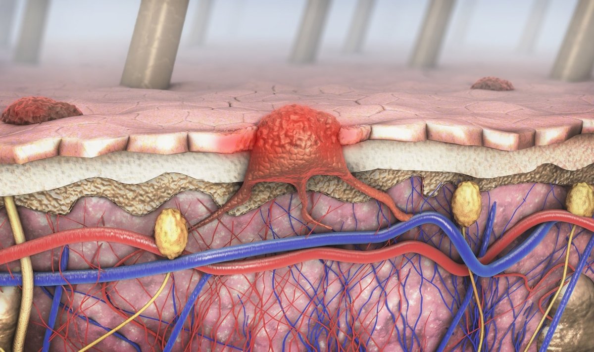 Melanoma