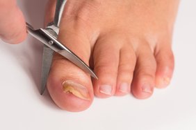 Diagnozė, subjaurojanti kojų nagus: tai – ne tik estetinė, bet ir sveikatai grėsmę kelianti liga