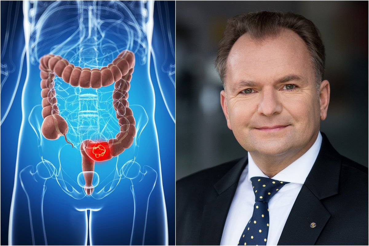 Storosios žarnos vėžys – tyli, bet pavojinga liga: profesorius įvardijo ...