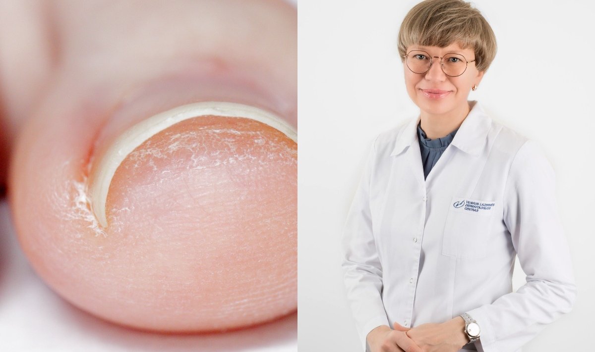 VUL Santaros klinikų gydytoja dermatovenerologė Edita Zubrickienė 