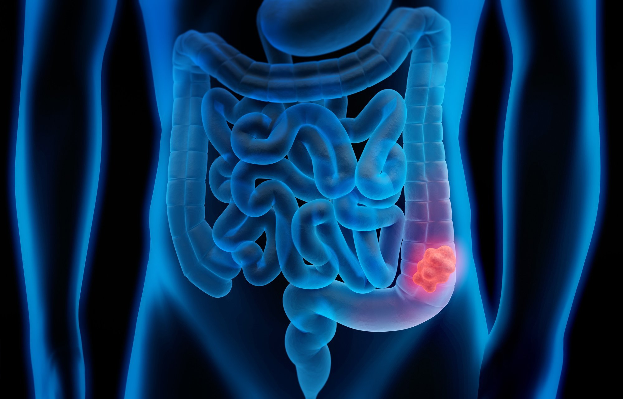 Scientists Offer New Explanation for Rising Colorectal Cancer Cases