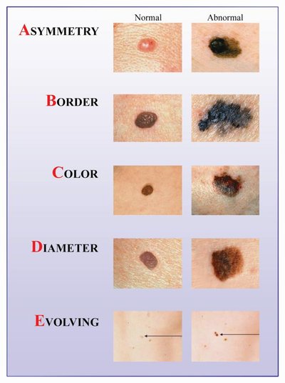 Melanomos