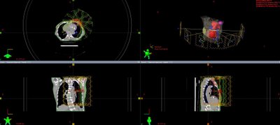 3D Spindulinio gydymo sistemos Eclipse programos langas