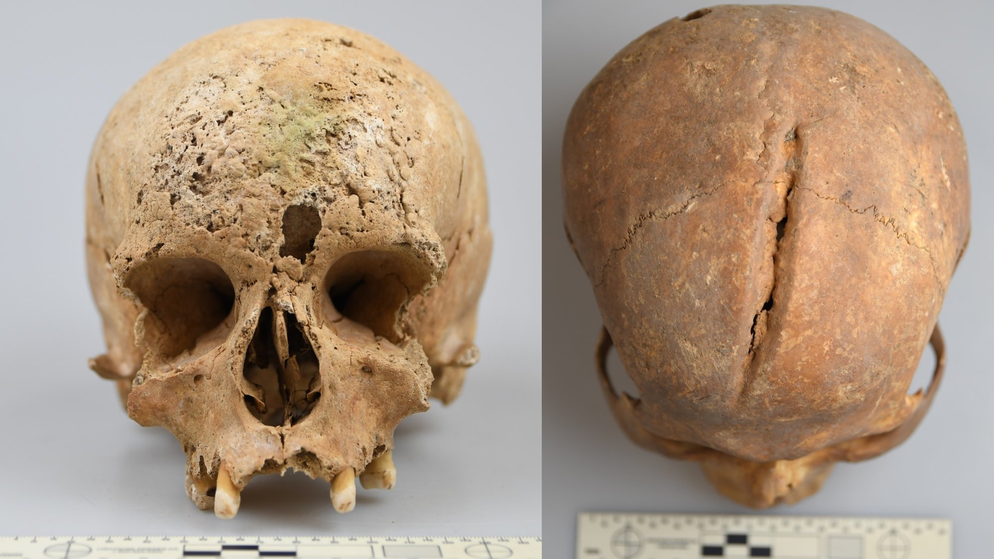 Scientists Uncover Vilnius's Past Through Skeletal Remains