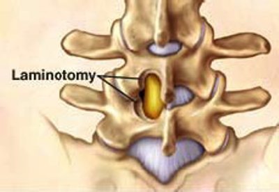 Vienpusė laminotomija