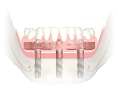 Apatinio žandikaulio nuolatinių dantų atkūrimas ant 3 implantų per vieną dieną