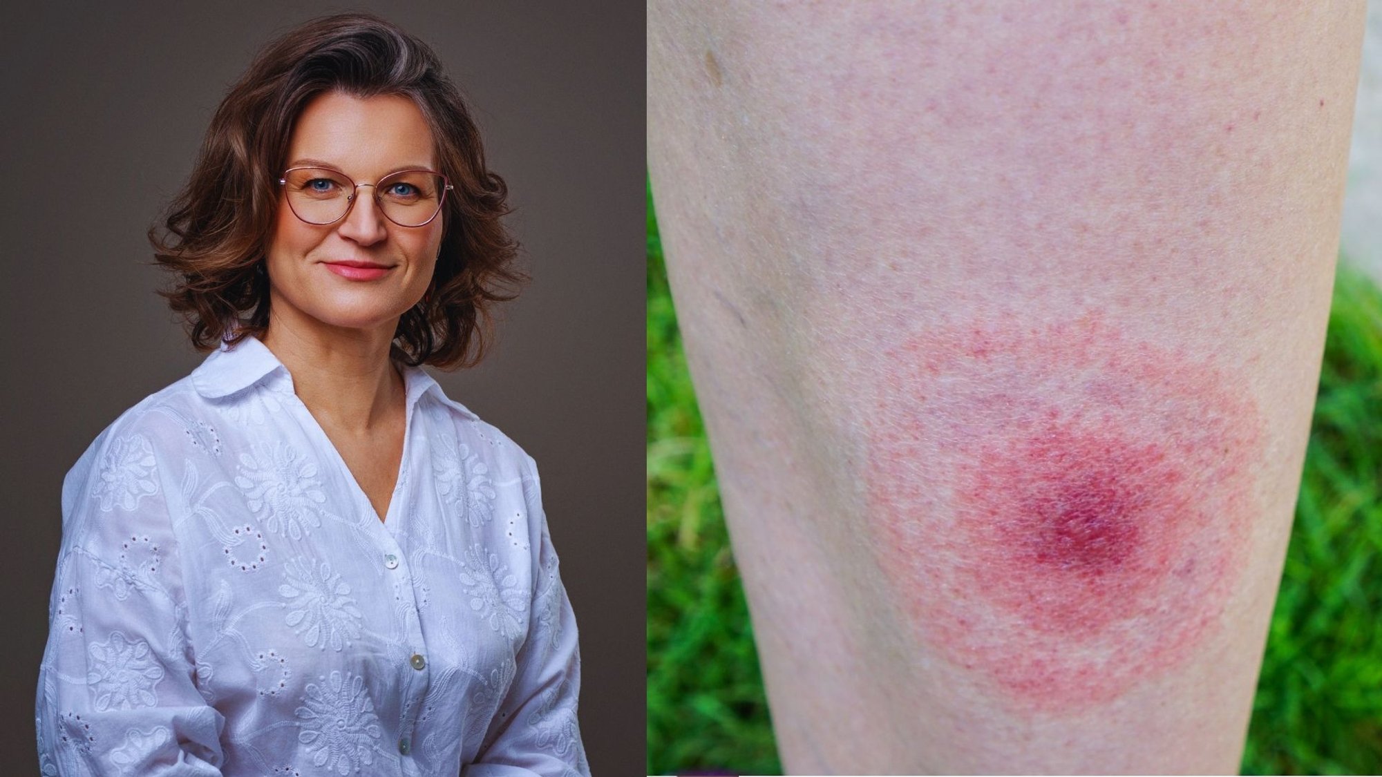 Simple habit can help prevent Lyme disease and tick-borne encephalitis, doctor says