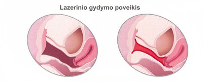 Lazerinio gydymo poveikis