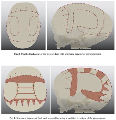 Kaukolės deformacijos (Journal of Cranio-Maxillo-Facial Surgery nuotr.)