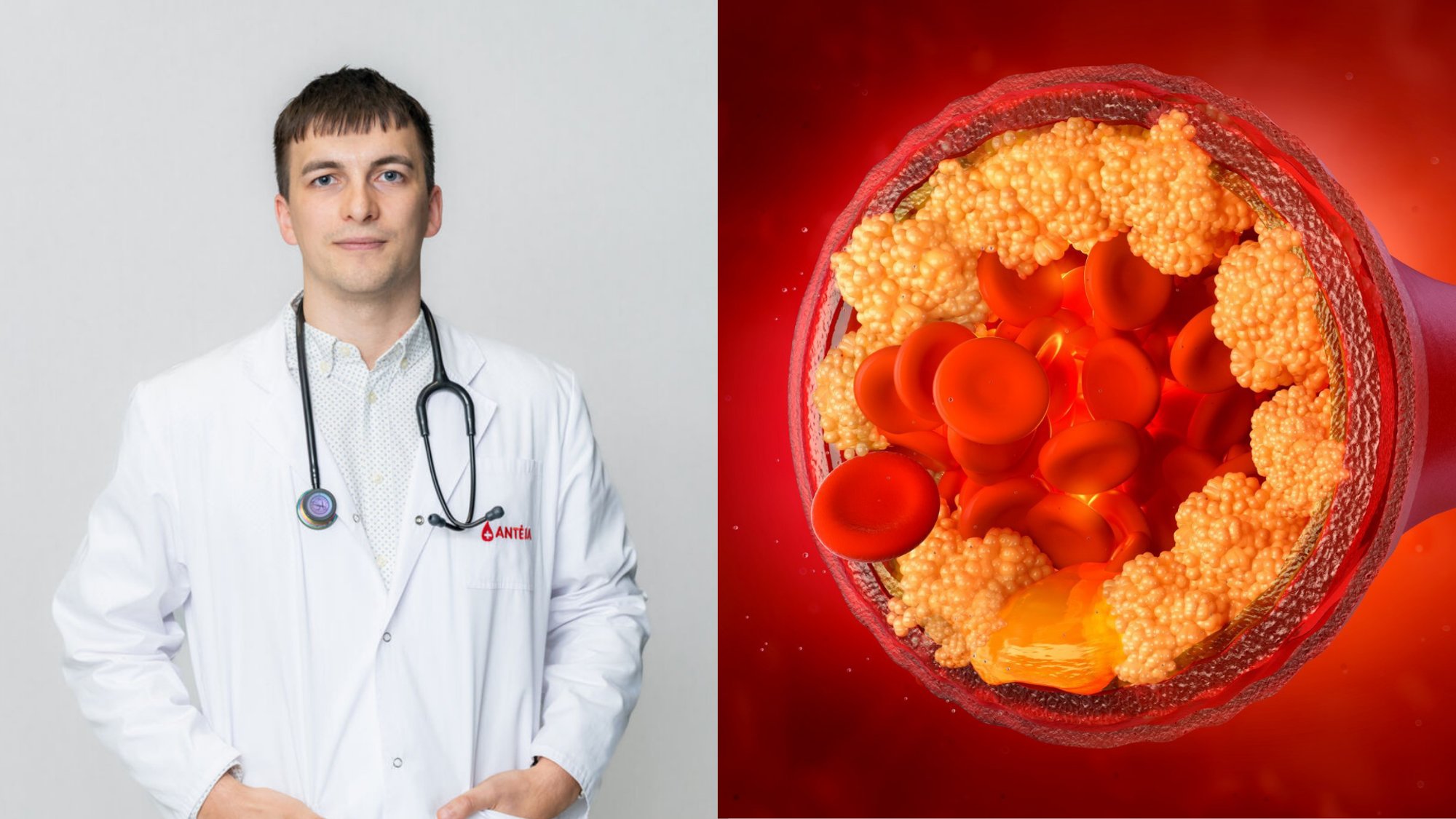 Healthy Lifestyle Not Always Enough to Lower High Cholesterol, Doctor Explains