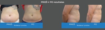  Rezultatai „Prieš“ ir „po“