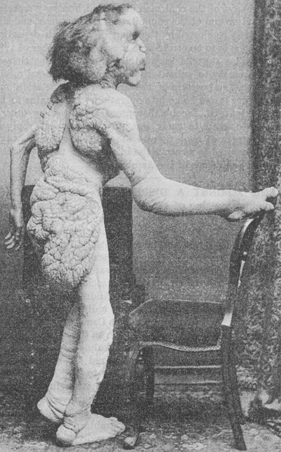 Joseph Merrick 1888