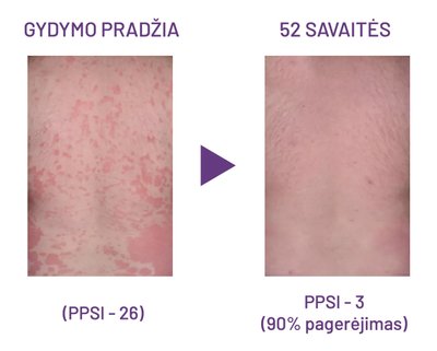 Psoriazė