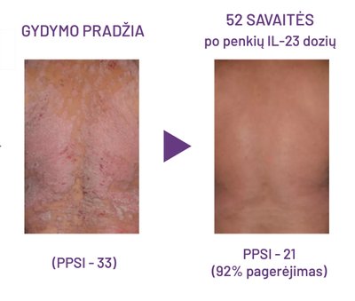 Psoriazė