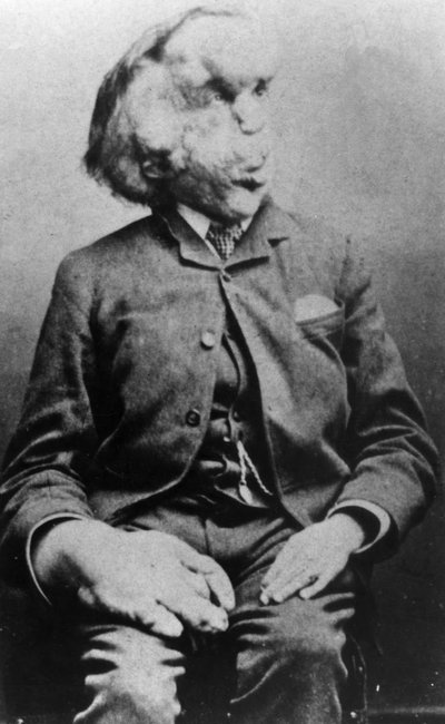 Joseph Merrick