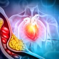 Mokslininkai įvardijo blogą įprotį, kuris padidina cholesterolio kiekį
