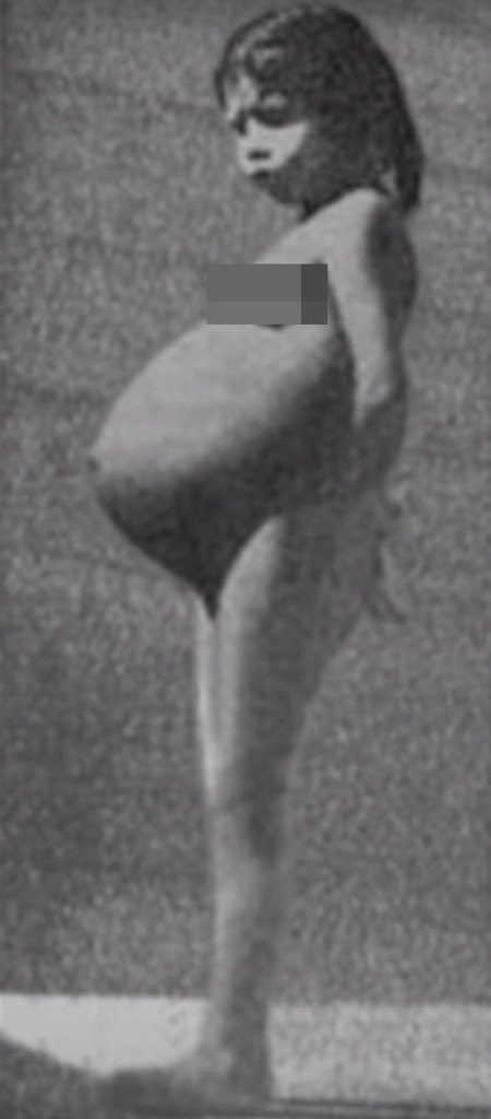 Lina Medina