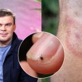 Gydytojas Morozovas: 3 Laimo ligos stadijos ir kada tyrimai nieko neparodys