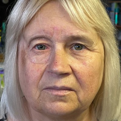 This woman lost her right eye and eyelid due to cancer. Now, they have been restored with Filonenko's help