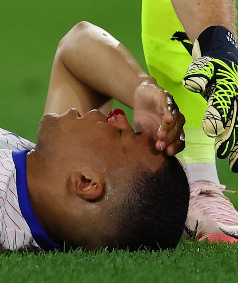 Kylian Mbappe po smūgio į varžovo petį, futbolininkui lūžo nosis 